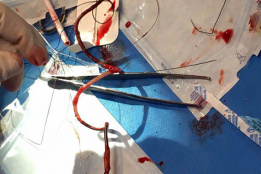 lead extraction  در بخش الکتروفیزیولوژی